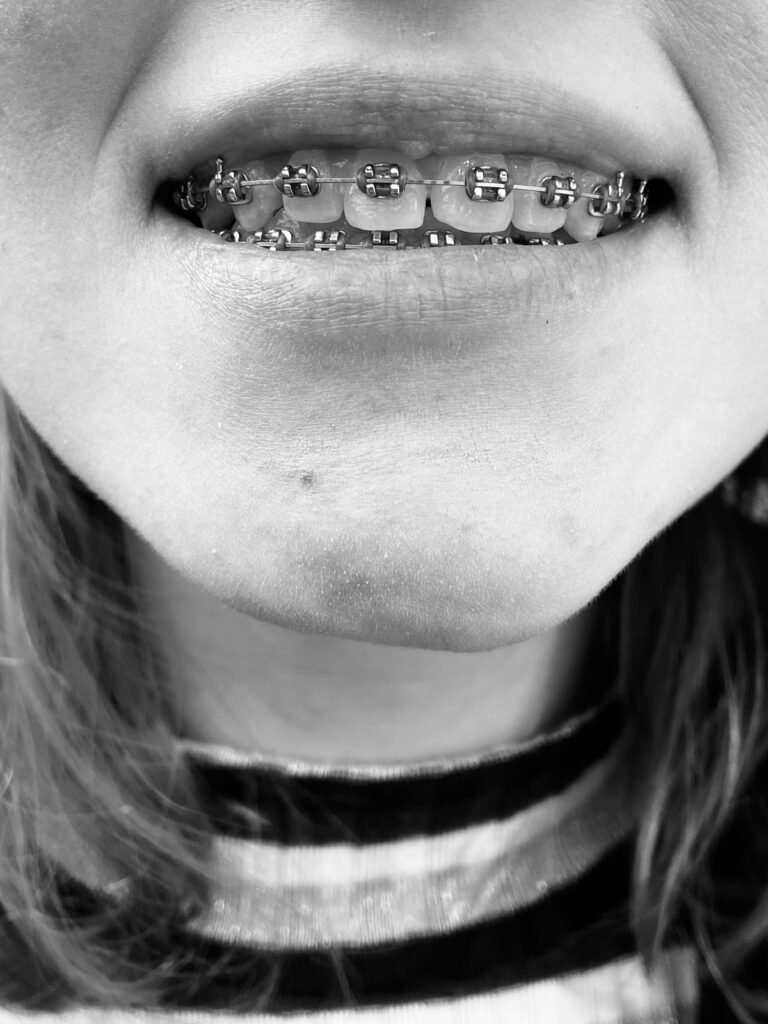 Close-up smile with dental braces, relevant to whitening with orthodontic work