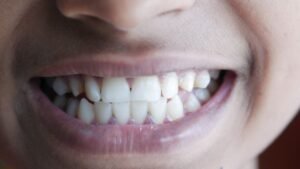 Close-up of a natural smile showing slightly yellow-toned teeth